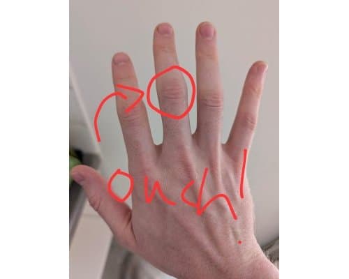 Picture showing my hand pain